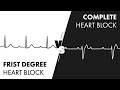 First vs Third Degree Heart Block