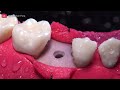 step by step dental implants in 4k