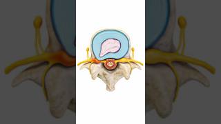 How disc Herniation heal #sciatica #discherniation