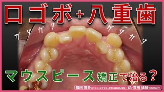 マウスピース矯正 八重歯＋口ゴボの症例経過【福岡 博多】治療期間や抜歯についても口コミでおすすめと評判の歯医者が解説。安い費用で矯正歯科を決めて失敗や後悔しないために見てください！