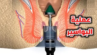 شاهد عملية ازالة البواسير خطوة بخطوة_Step-by-step haemorrhoidectomy