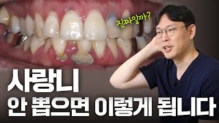 괜찮을 줄만 알았던 내 사랑니🦷 염증은 이렇게 생깁니다ㅣfeat.잇몸자가진단방법📋