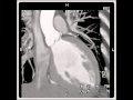 Cardiac: diseased aortic valve with aortic valvular stenosis (2 of 10)