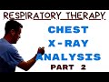 Respiratory Therapist - Chest Radiograph Interpretation Part 2 - Guess the CXR!