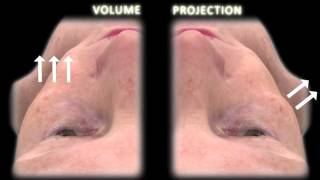 Volumizing Viaducts of the Midface: Defining the Beut Techniques