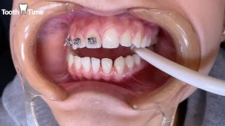 Dental BRACES with Dr. Williams - What to Expect at your first appointment