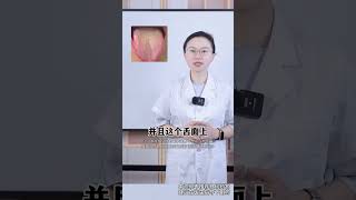 这种舌头虽然也是湿热，但龙胆泻肝丸对他确没啥用 #健康科普  #中医文化