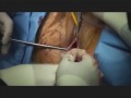 Neomedic SURELIFT prolapse system