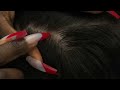 asmr 2hrs intense nitpicking u0026 deep scalp scratching triggers allzoomed