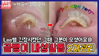 (ENG SUB)모두를 초긴장시켰던 최고난도 골뱅이 내성발톱! 2차관리! ingrown toenail / ingrowing nail - 풋풋한리쌤 성수점 / 남양주호평점