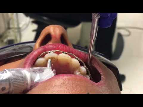Air Polisher Video Air Polisher Video