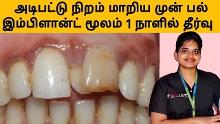 அடிபட்டு உடைந்த முன் பல்?  இம்பிளான்ட் மூலம் 1 நாளில் பிக்சட் பல்