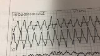 DKA Clinical Case Discussion