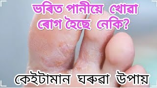 ভৰিত পানীয়ে খোৱা ৰোগ হৈছে নেকি? কেইটামান ঘৰুৱা উপায়@bondorobasomia8584