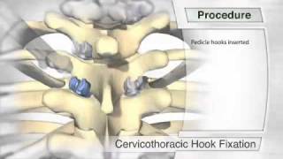 Cervicothoracic Hook Fixation Procedure