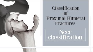 proximal humeral fracture classification - Neer classification (subtitled)