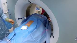 Renal tumour microwave ablation under CT guidance