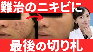 【ニキビ治療】イソトレチノインについて皮膚科専門医が徹底解説