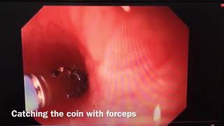 Esophageal coin