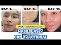 BEFORE AFTER LASER CO2 FRACTIONAL | UPDATE PROGRESS MENGURANGI BOPENG