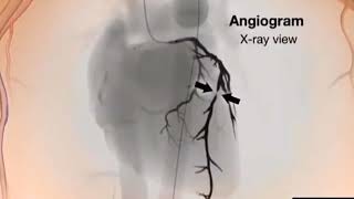 Coronary angioplasty (ರಕ್ತನಾಳ ಸುರೂಪಿಕ ಚಿಕಿತ್ಸೆ) PTCA first developed in 1977 by Andreas Gruentzig.