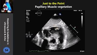 Papillary Muscle vegetation