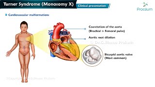 Turner Syndrome ( Monosomy X ) : Genetics , Clinical presentation ,  Diagnosis , Management