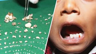 Doctors Remove Over 500 Teeth From Boy's Mouth