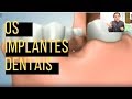 SEGURANÇA PARA MASTIGAR E SORRIR COM IMPLANTES. ASSISTA E COMECE A PENSAR NISSO