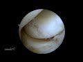 BioCartilage® Extracellular Matrix Mixing and Delivery Advancements in the Elbow