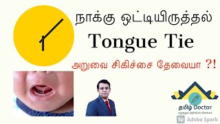 நாக்கு ஒட்டி இருத்தல் | Tongue Tie in Babies | When to Intervene | தமிழ்