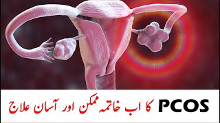 What is PCOS Treatment? pcos ka ilaj | Lifestyle Modification... | Pcos ka nuskha..