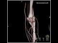 vascular ct angiography of the forearm with vascular mapping 5 of 5