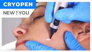 TAKE 10 YEARS OFF WITH THE CRYO PEN  | New You Med Spas