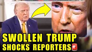 🚨Trump STUNS The Media With SWOLLEN EYE And CRAZY INTERVIEW