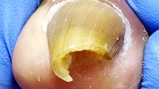 The Sharp Ingrown Toenail Made A Hole, Professional Pedicure【Xue Yidao Pedicure】