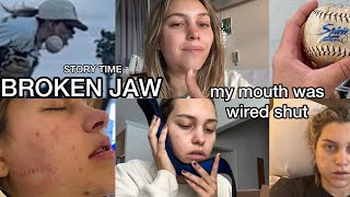 STORY TIME: Softball Accident Broke my Jaw! wired shut and surgery - San Diego,