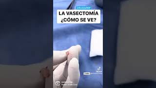 ASÍ SE VE LA VASECTOMÍA - Esterilización Masculina