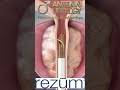 Antonini Urology Roma Milano Madrid Dubai +39 351 784 4455 #rezum #prostata #ipb