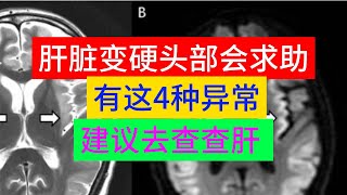 肝脏变硬，头部会“求助”？有这4种异常，建议去查查肝