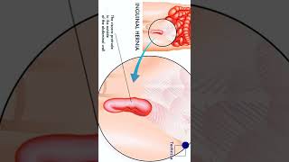 ഹെർണിയ | ഹെർണിയ ഈ ലക്ഷണങ്ങൾ കാരണങ്ങൾ നിസാരമാക്കരുത് | Hernia Treatment | #shortvideo | Techzila