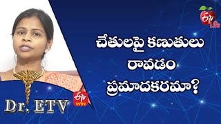 చేతులపై కణుతులు రావడం ప్రమాదకరమా? | డాక్టర్ ఈటీవీ  | 6thఫిబ్రవరి 2023