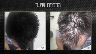 הדמיית שיער לגבר מיקרופיגמנטציה לגברים תל אביב