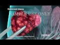 breast cancer breast biopsy nucleus health