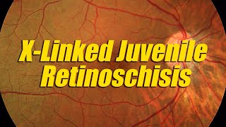 X linked Juvenile Retinoschisis | #shorts