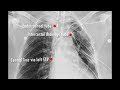 Chest X-ray: Tubes/ Catheters