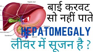 पाचन खराब रहने पर कौन सी दवा लेनी चाहिए// Best Homeopathic Medicine for treatment of Hepatomegaly