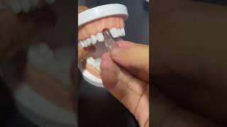 🦷$2000 for dentist Or 20 buck for Yutooth be？#repair#🦷🦷#fixtooth#teethtok  #savemoney #health