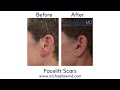 facelift scars