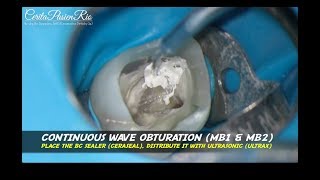 continuous wave obturation bioceramic sealer ceraseal metabiomed curve canal molar